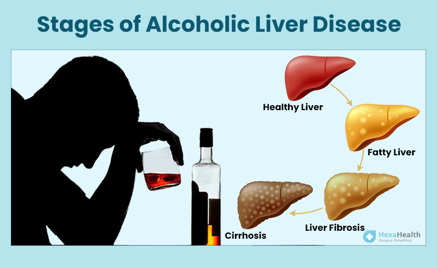 Stages of Alcoholic Liver Disease - How These are Treated?