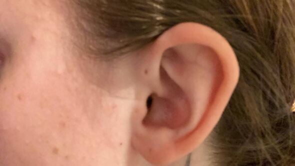 exploring-mystery-preauricular-pits-uncommon-yet-fascinating-ear-birth-irregularities