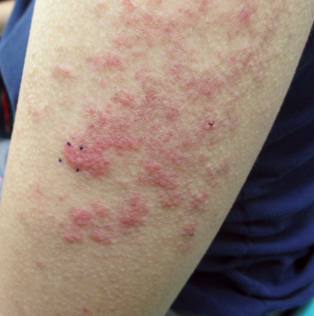 List 91+ Pictures Pictures Of Skin Rashes On Arms Completed 10/2023