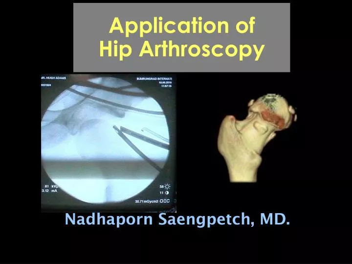 application of hip arthroscopy