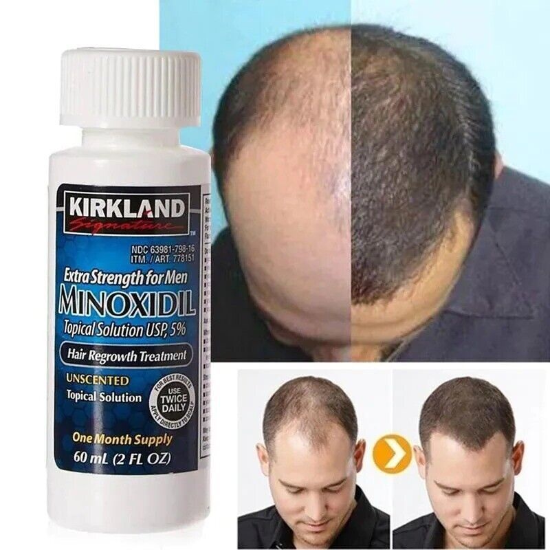 Jual Minoxidil 5% Kirkland FDA Minoxidil Original Kirkland Minoxidil ...