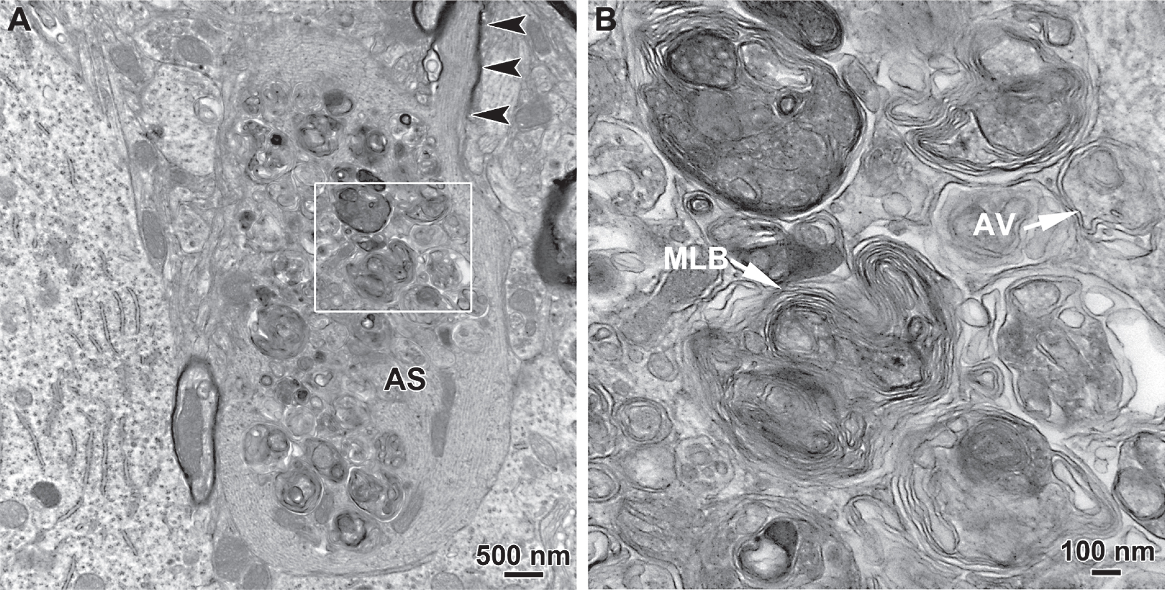 Transmission electron microscopic analysis of axonal spheroids in the medial forebrain bundle in the hLRRK2(R1441G) BAC transgenic mice revealed the presence of giant axonal spheroids containing large numbers of autophagic vacuoles. In A, a thinly myelinated axon (arrowheads) with well-organized cytoskeletal elements leads into a large spheroid that lacks myelin, contains disorganized cytoskeletal structures and is packed with autophagic vacuoles. The region in the white box is shown at higher magnification in B. Numerous vacuoles with double membranes, characteristic of autophagic vacuoles (AV), are observed. Interspersed among them are numerous multilamellar bodies (MLB).