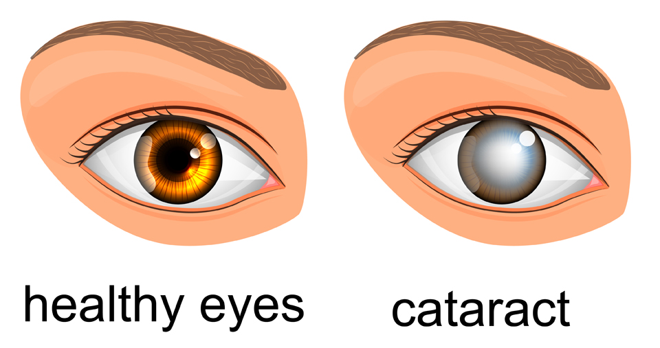 Cataracts.