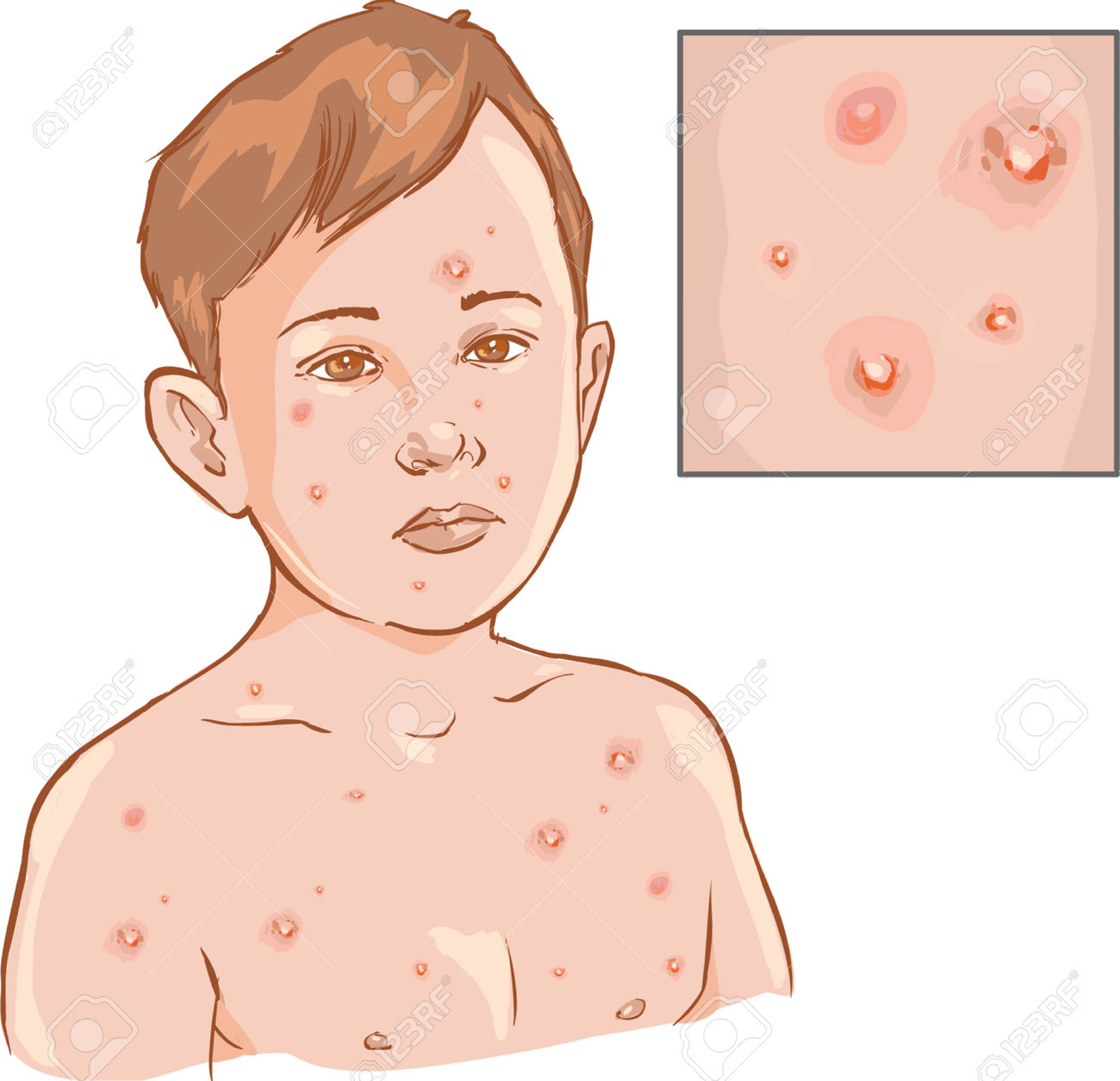 White Background Vector Illustration Of A Chicken Pox Royalty Free.