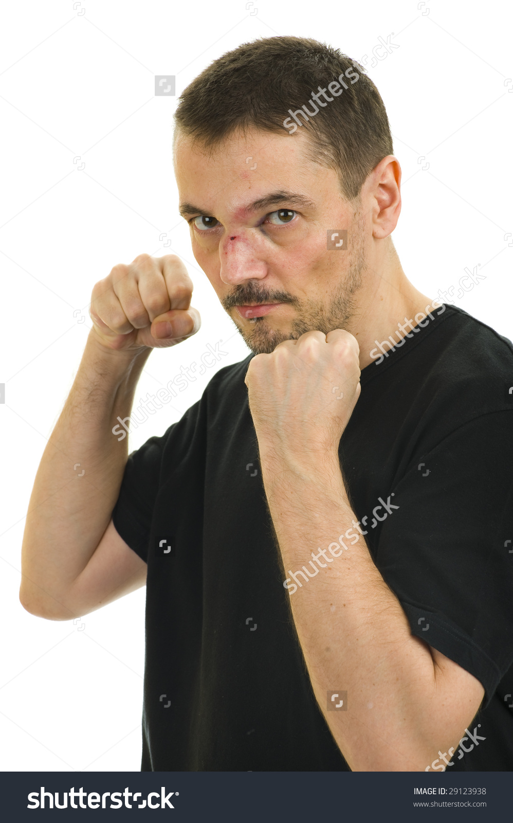 Man With Broken, Crooked Nose And Black Eye Isolated On White.