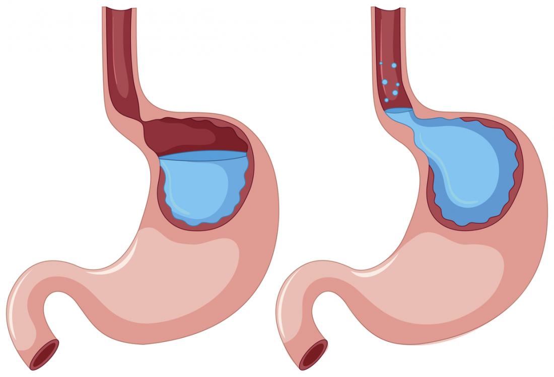 Gastroesophageal Reflux.