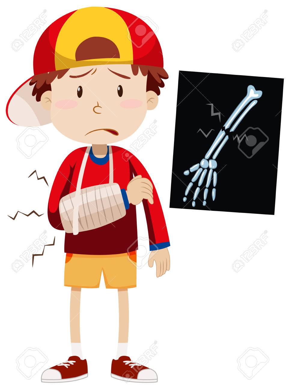 Broken Arm Clipart.