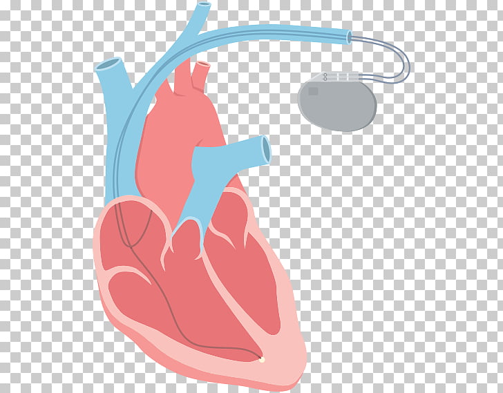 Heart arrhythmia Tachycardia Catheter ablation, heart beat.