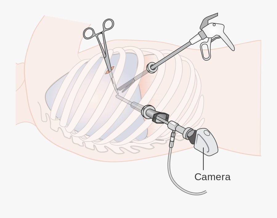 Thoracoscopic Lung Biopsy , Free Transparent Clipart.