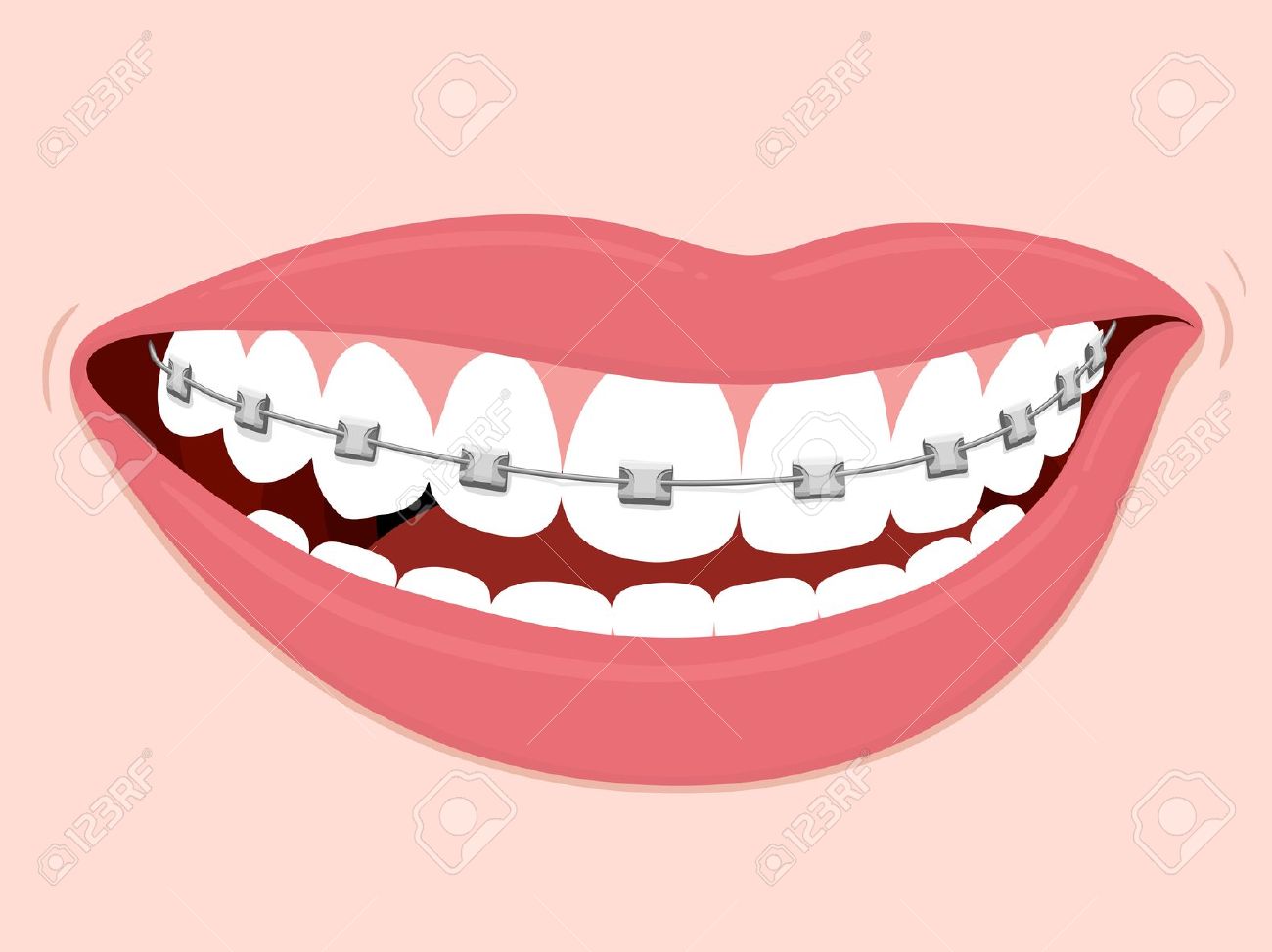 Clipart brace smile no background.