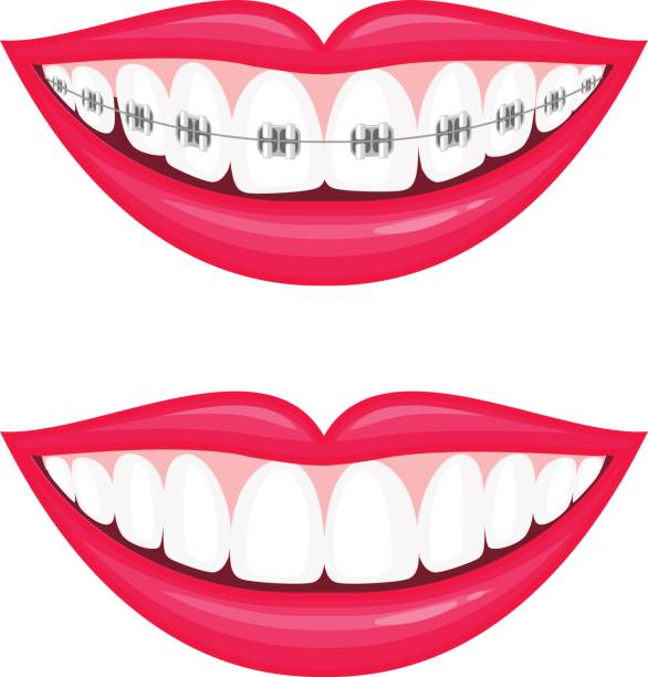 281 Braces free clipart.