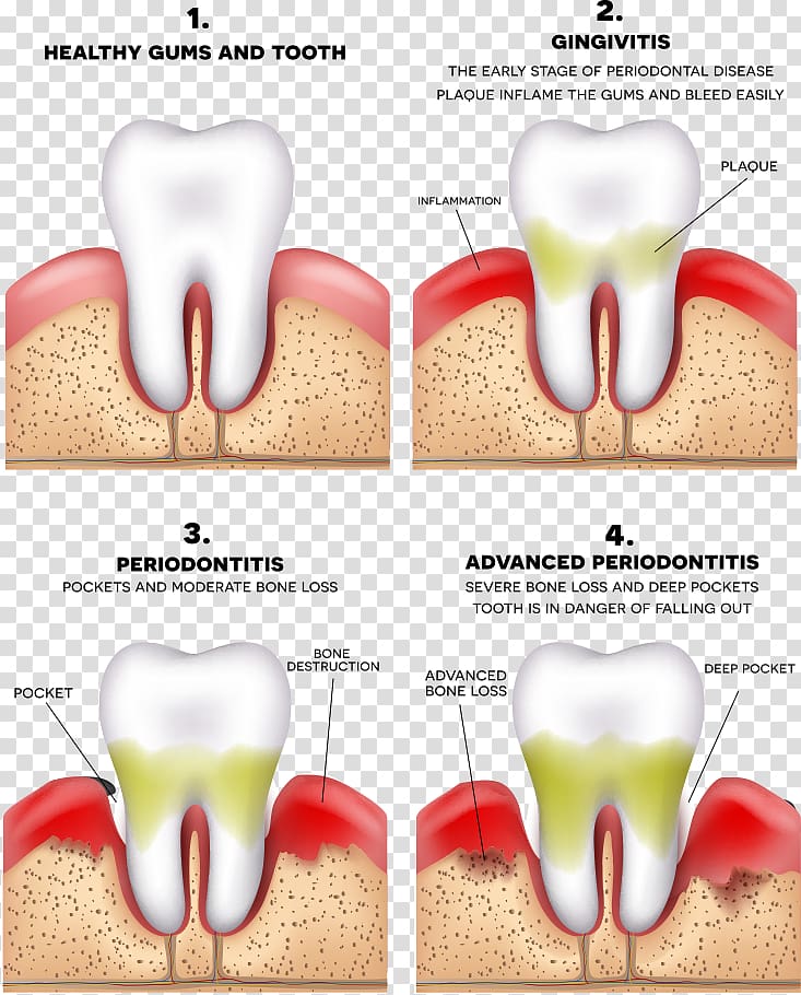 Four tooth chart, Periodontitis Disease Gums Periodontology.