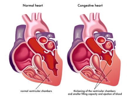 143 Congestive Heart Failure Stock Illustrations, Cliparts And.