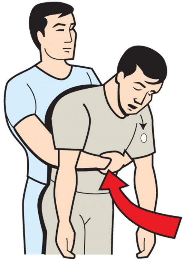 Heimlich maneuver clipart 9 » Clipart Station.