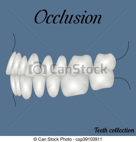 Vector Clip Art of occlusion side view.