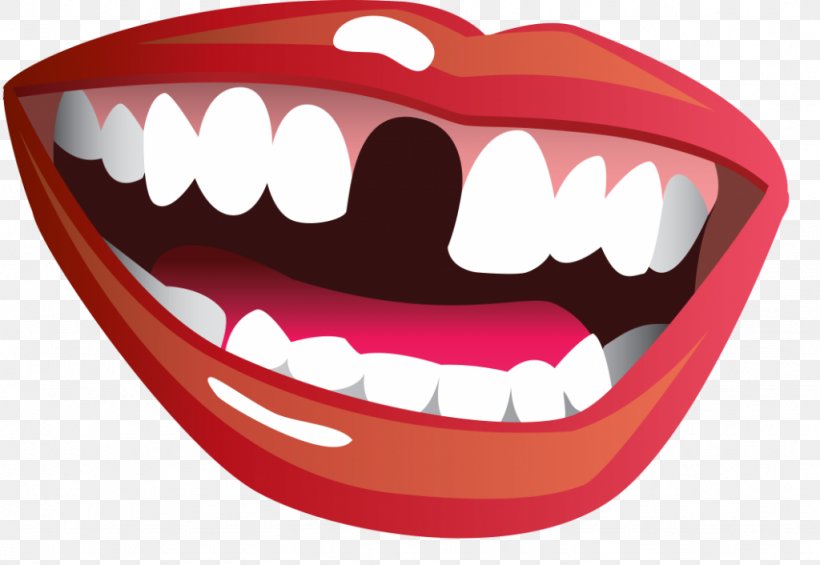 Tooth Loss Mouth Smile Clip Art, PNG, 1024x706px, Watercolor.