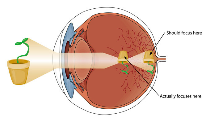 Refraction errors: Short sightedness (nearsightedness).