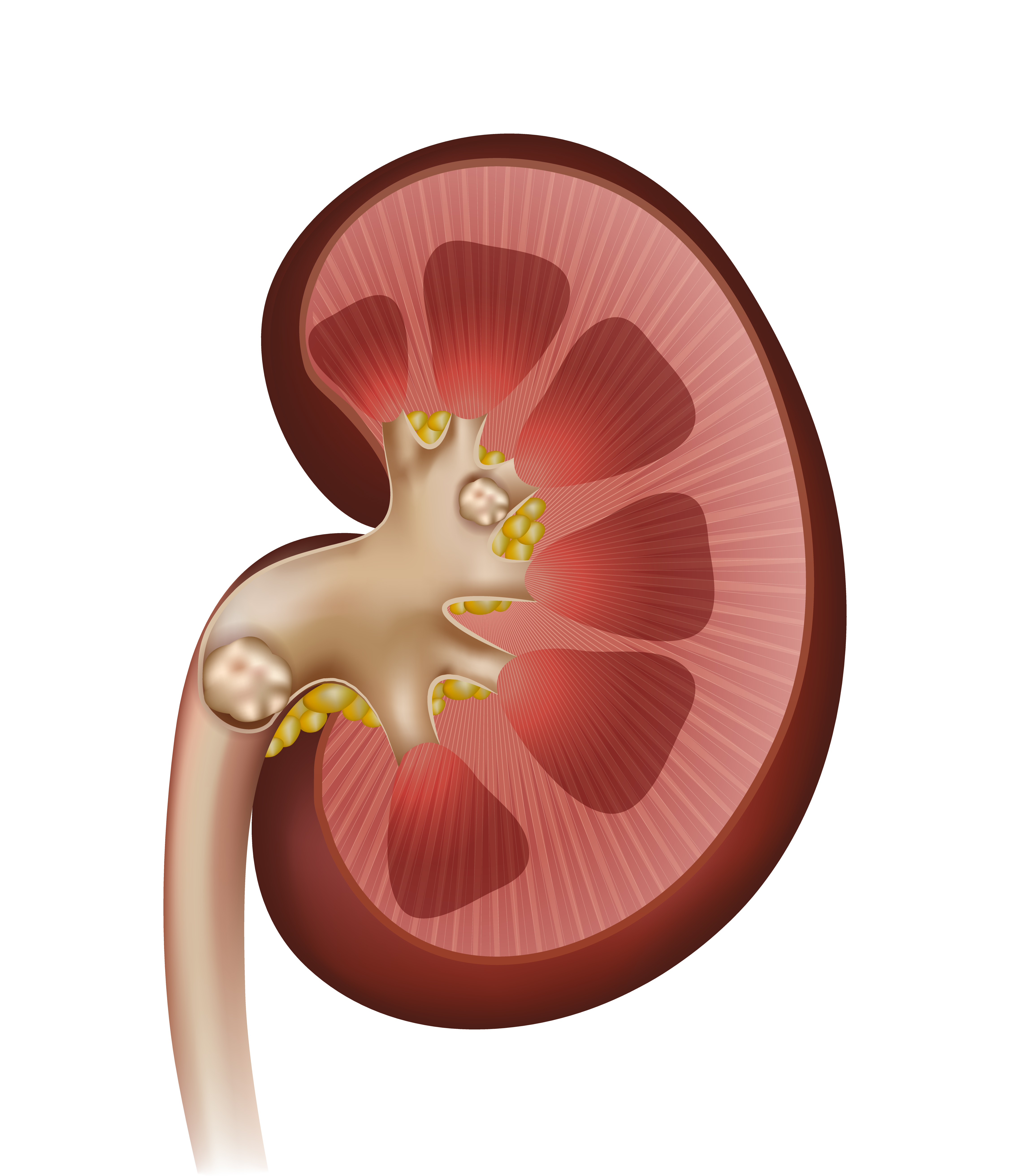 Kidney Stones Chattanooga.