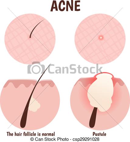 Vector Illustration of structure of the hair follicle, problem.