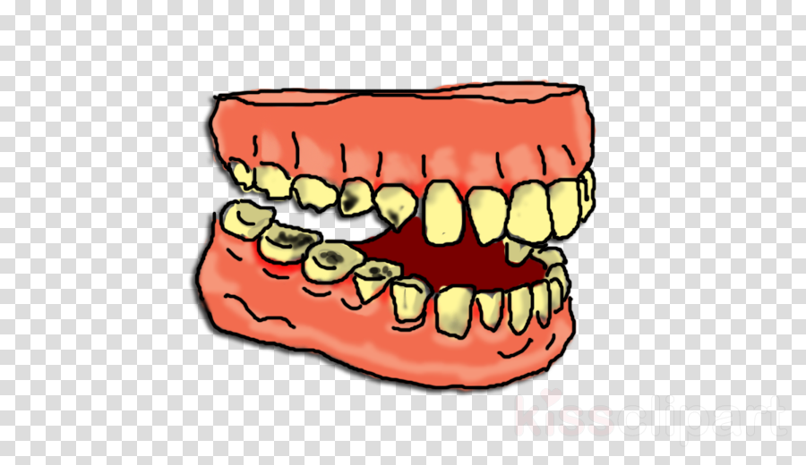 Download tooth decay clipart Tooth decay Human tooth Clip art.