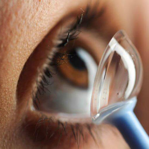 Scleral Lens - Lenses Color: Transparent