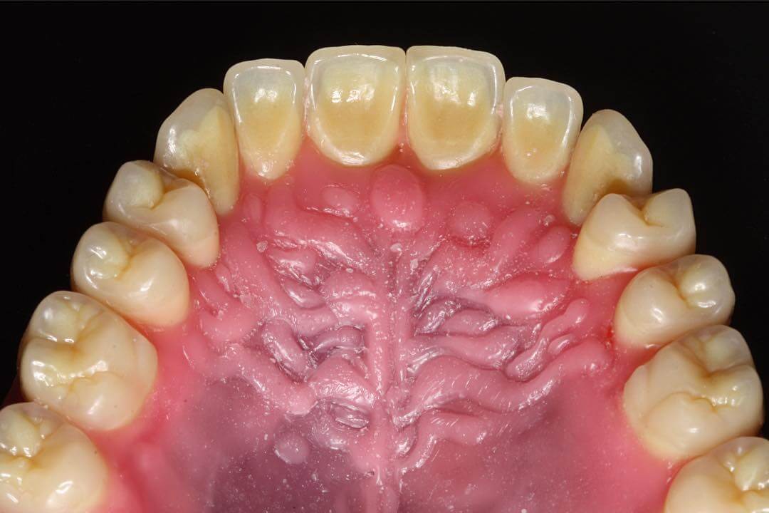 Hard Palate as related to Mouth and Teeth - Pictures