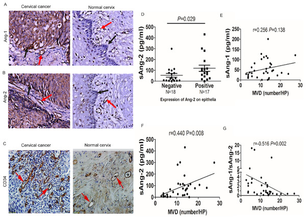 sAng-2 concentration positively relates with Ang-2 expression on the epithelia and MVD in cervical tissues.