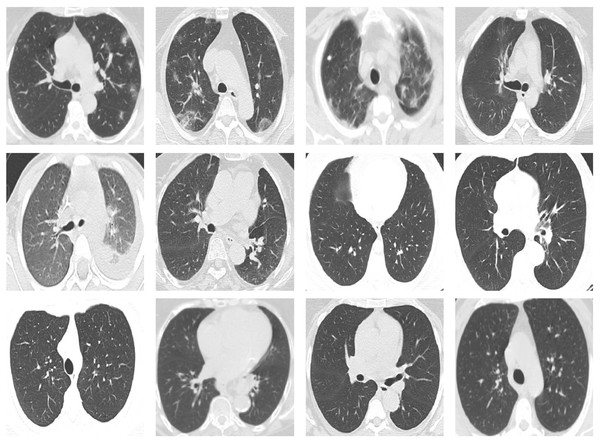 Sample CT images from the SARS-CoV-2 CT scan dataset.