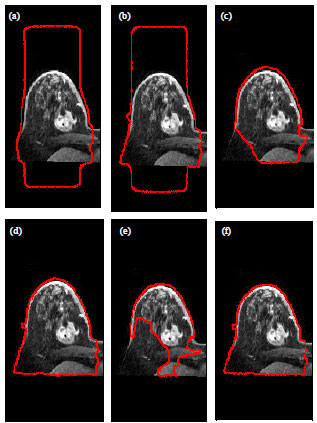 Image for - MRI Breast Skin-line Segmentation and Removal using Integration Method of Level Set Active Contour and Morphological Thinning Algorithms