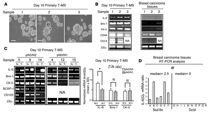 IL-6 mRNA is expressed in MS and in basal-like breast carcinoma tissues....