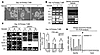 IL-6 mRNA is expressed in MS and in basal-like breast carcinoma tissues.