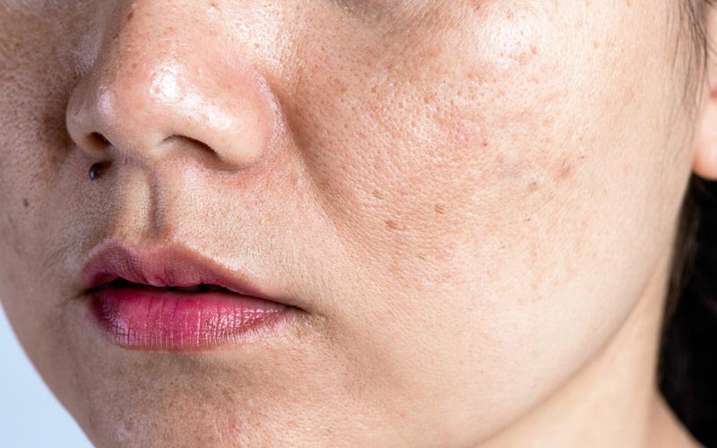 open pores on face