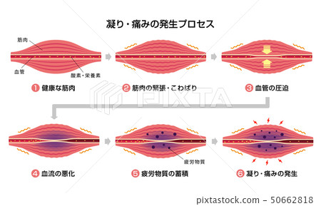 Stiff neck (stiffness) · Pain generation process (6 steps) Illustration 50662818