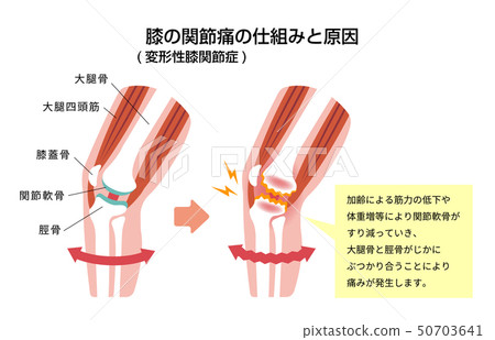 Mechanism and cause of knee joint pain (degenerative knee arthritis) 50703641