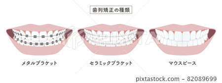 Orthodontic type set illustration 82089699