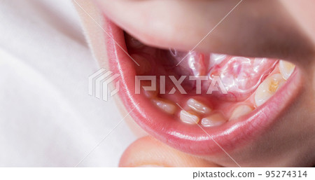 A child's tooth grows second next to the milk teeth. Formation of the jaw and permanent teeth in children. Removal of milk teeth, close-up 95274314