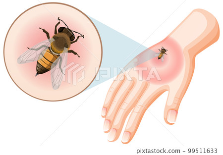 Bee bites sting on skin 99511633