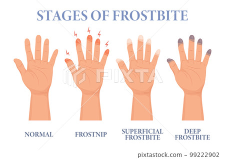 Frostbite stages. Frozen hands in different stages. Medical frostbite. Skin burn symptom. Health care medical concept. Vector 99222902