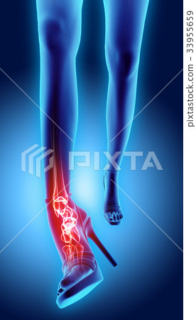 Ankle high heeled painful - skeleton x-ray. 33955659