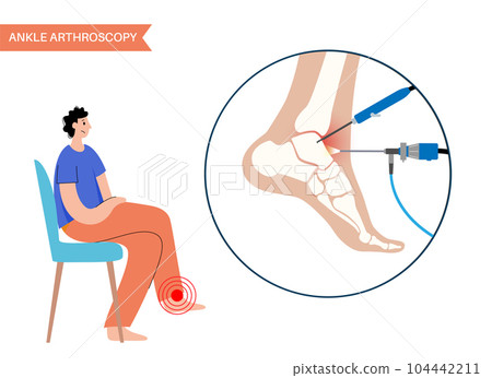 Ankle arthroscopy poster 104442211