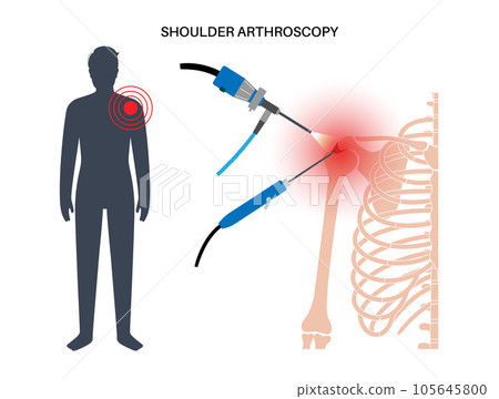 Shoulder arthroscopy poster 105645800