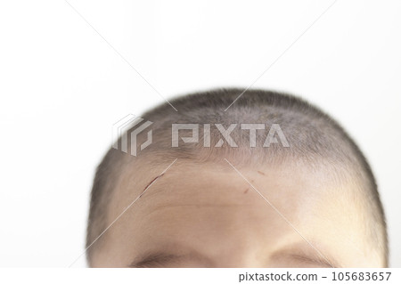 Baby's forehead scratch (boy, Japanese, 0 years old) 105683657