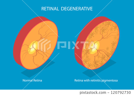 3D Isometric Flat Vector Illustration of Retinal Degenerative , Vision Impairment, Blind Spots 120792730