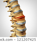 Thinning Spinal Disc 121207425