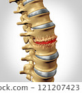 Spinal Osteophyte Formation 121207423