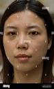 Zhao Yan, 27, one week after an operation to give her double ...