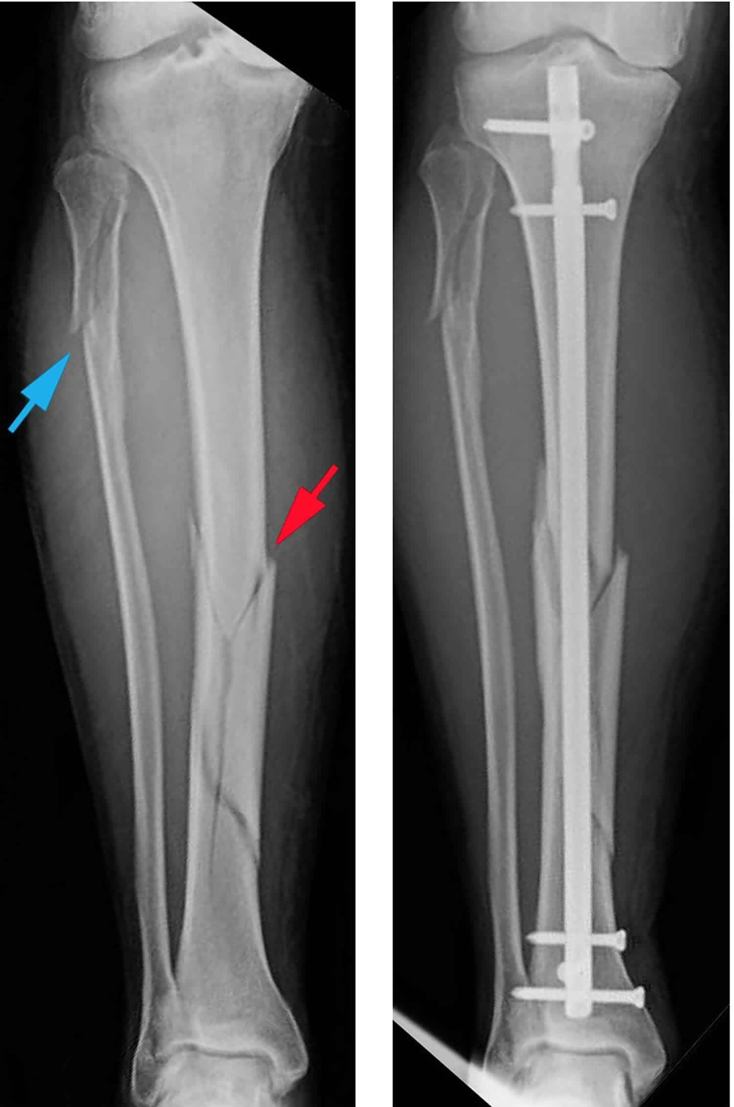 Spiral Bone Fracture