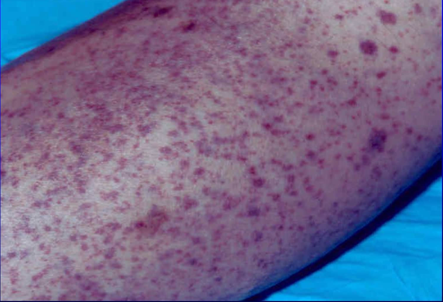 Petechiae