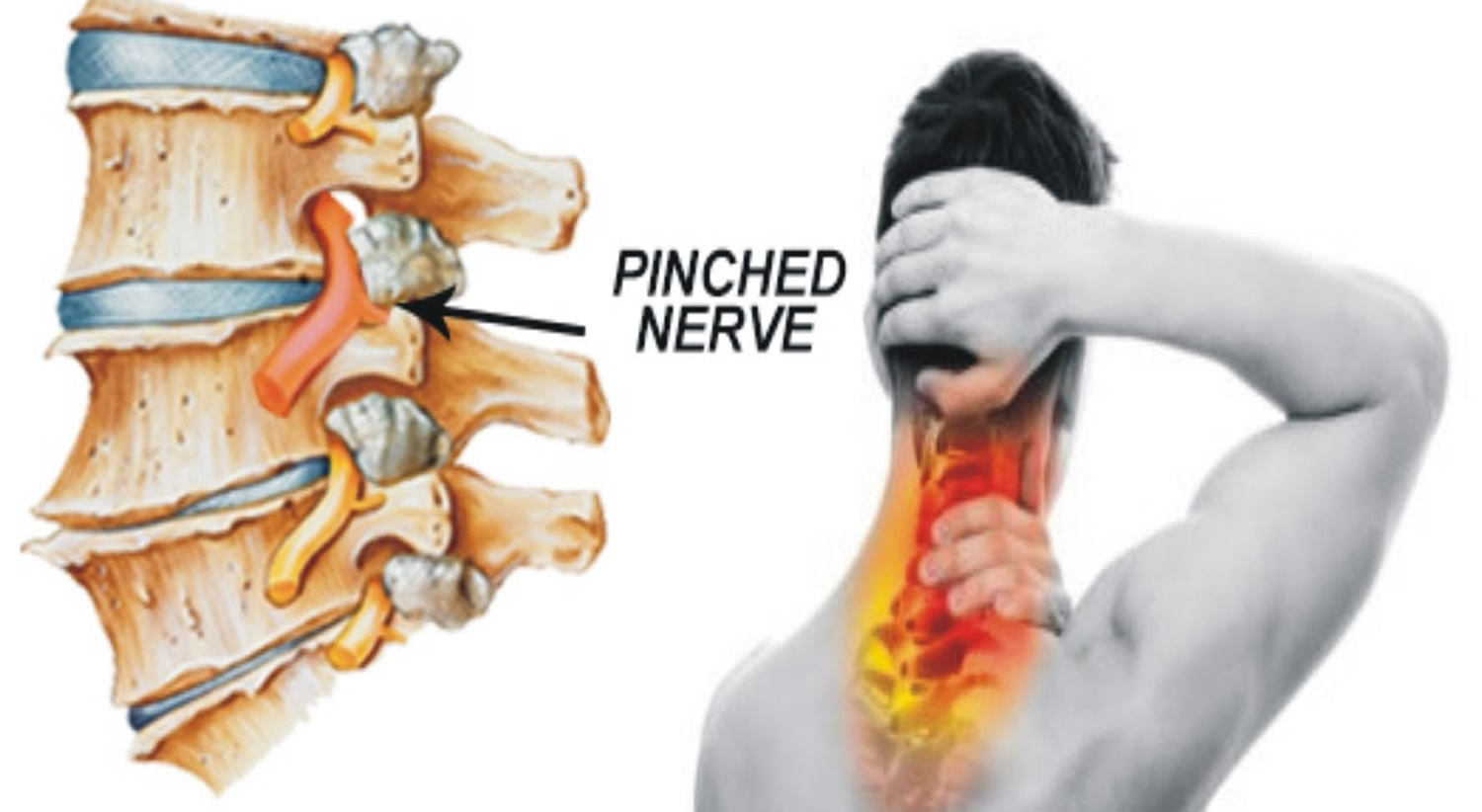 Pinched Nerve MRI