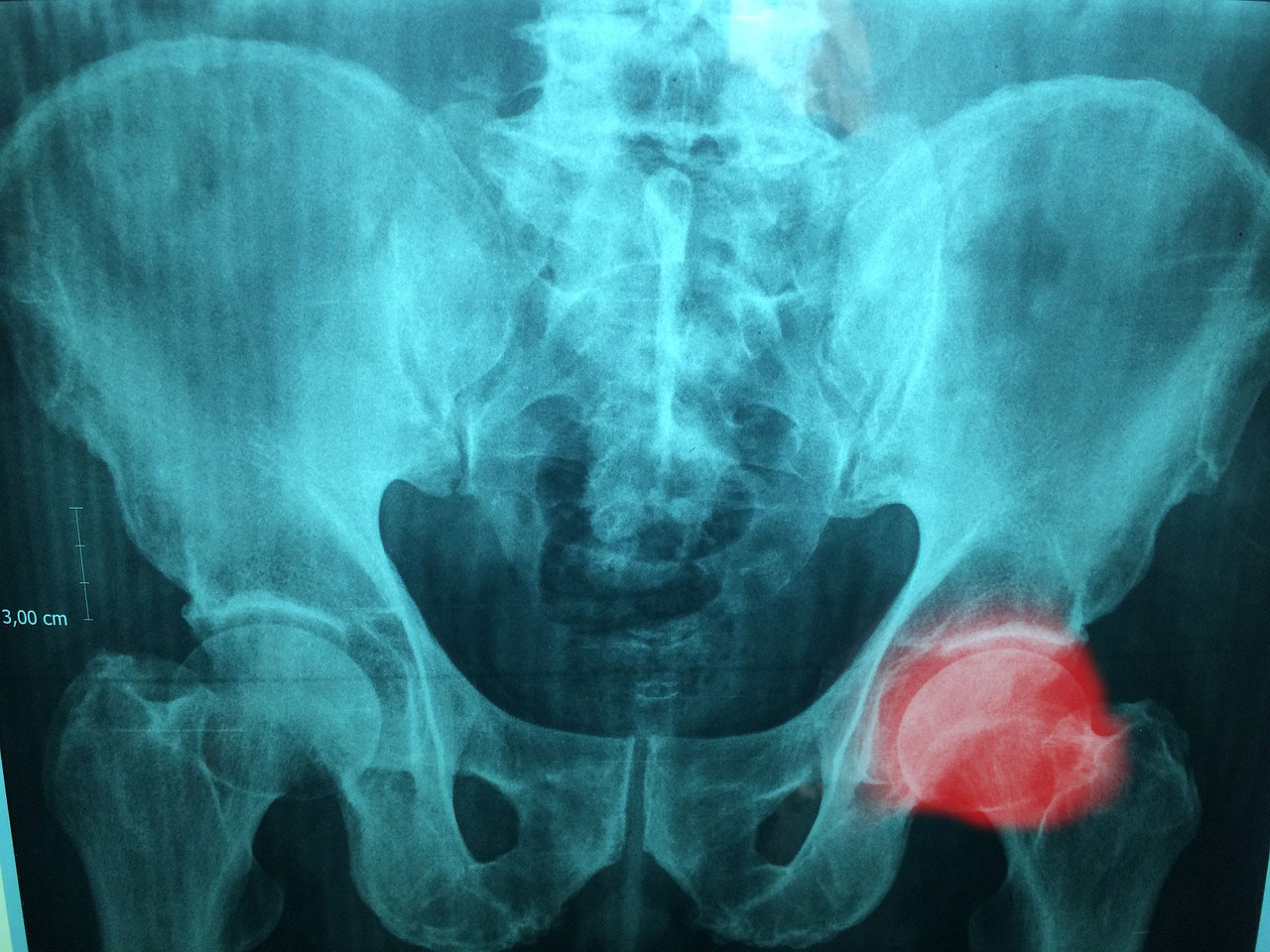 Severe Symptoms Of Hip Bursitis